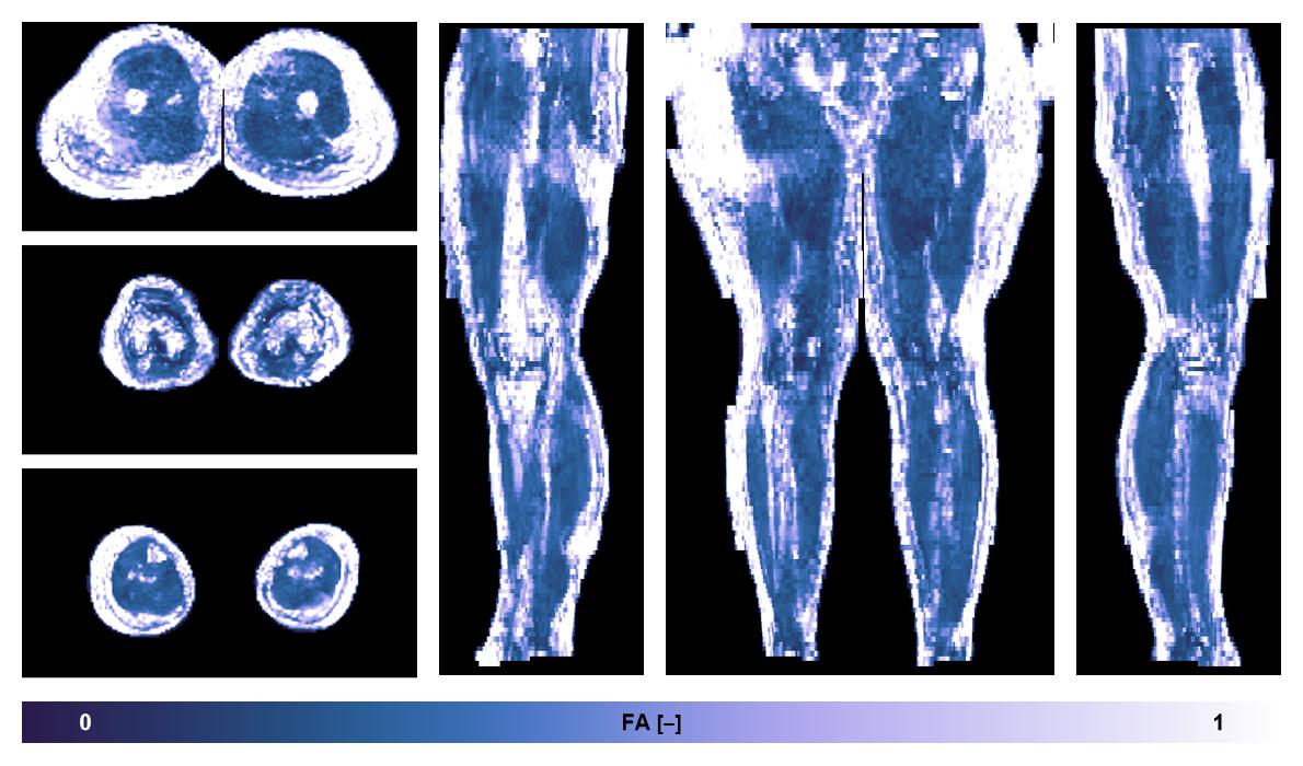 IVIM corrected whole leg muscle fractional anisotropy obtained from diffusion tensor imaging.