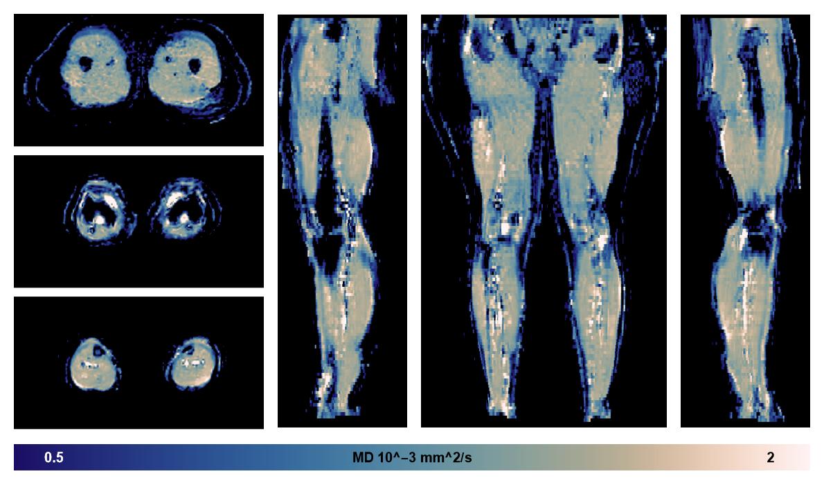 IVIM corrected whole leg muscle mean diffusivity obtained from diffusion tensor imaging.