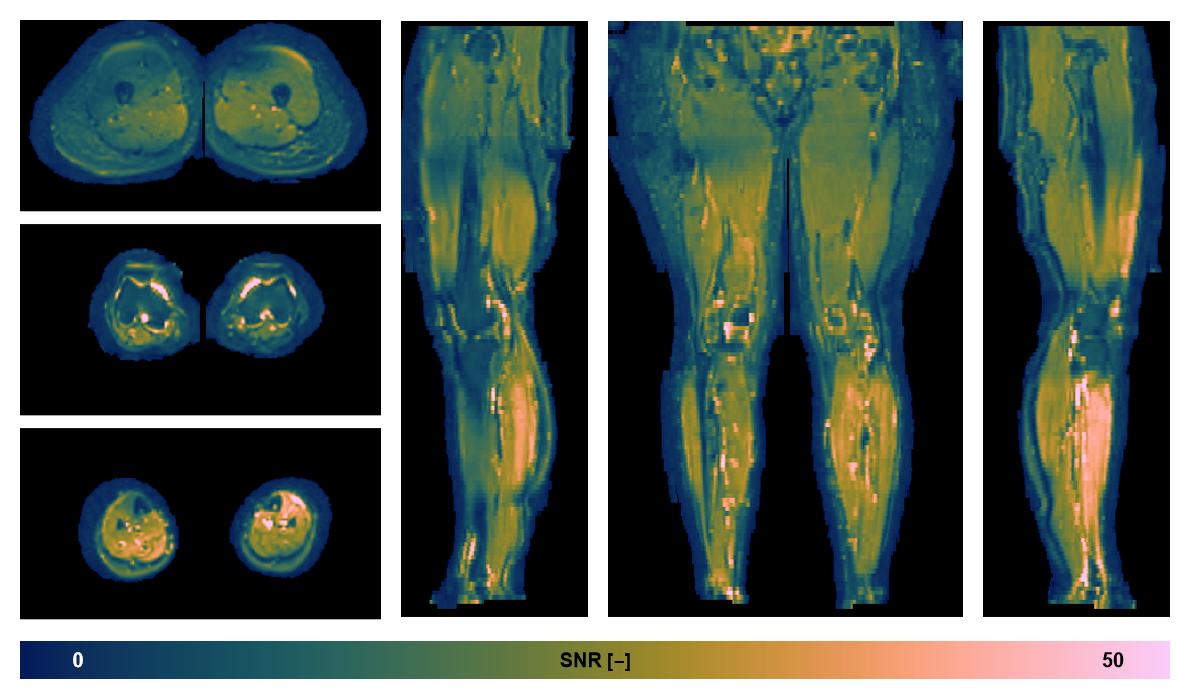 SNR distribution of the unweighted diffusion data.