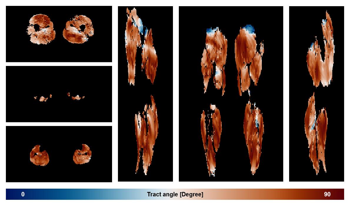 Muscle fiber tract angle map based on whole leg DTI based fiber tractography.