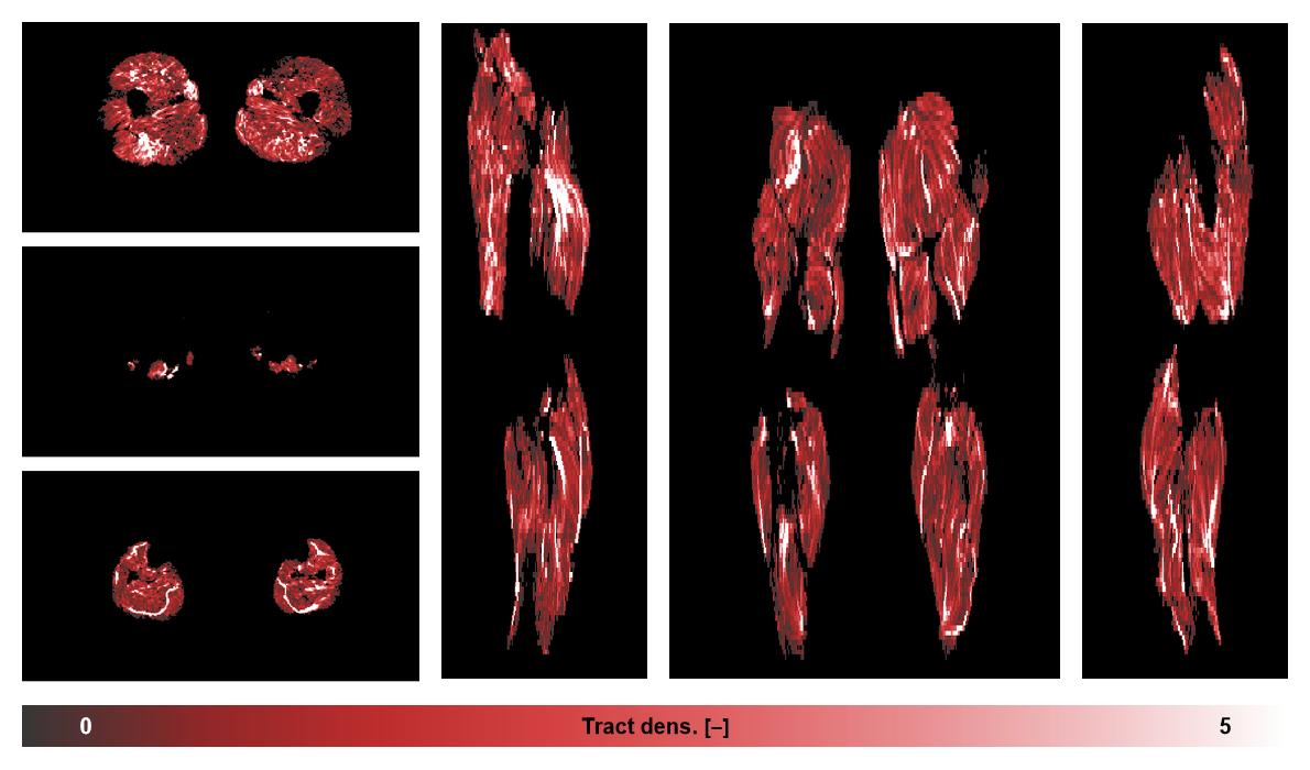 Muscle fiber tract density map based on whole leg DTI based fiber tractography.