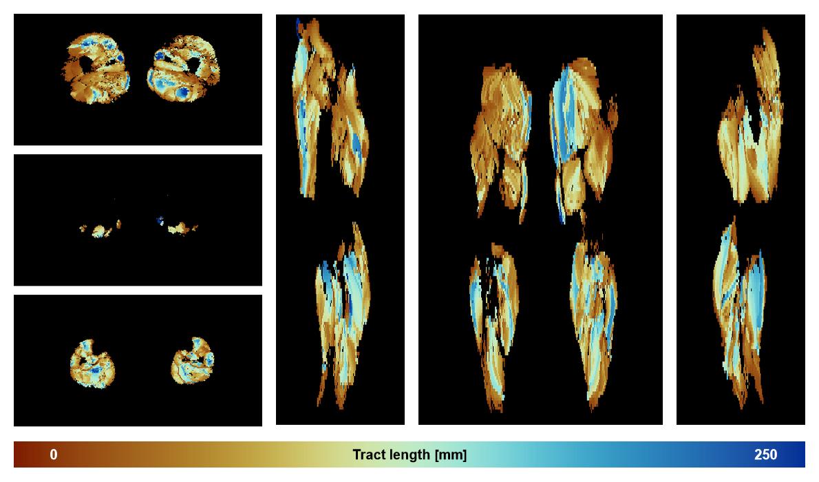 Muscle fiber tract length map based on whole leg DTI based fiber tractography.