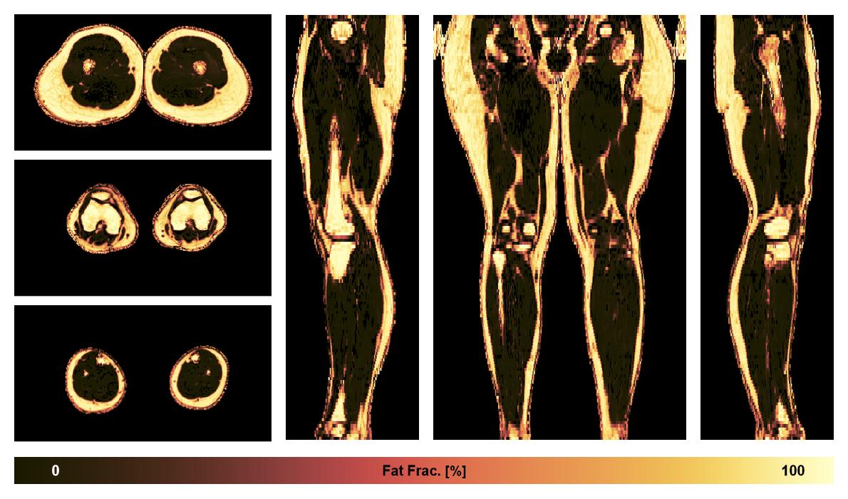 The fat fraction of the lower extremity obtained from the dixon reconstruction for muscle water fat quantification.