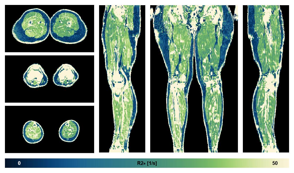 The R2 star relaxation time of the lower extremity obtained from the dixon reconstruction for muscle water fat quantification.