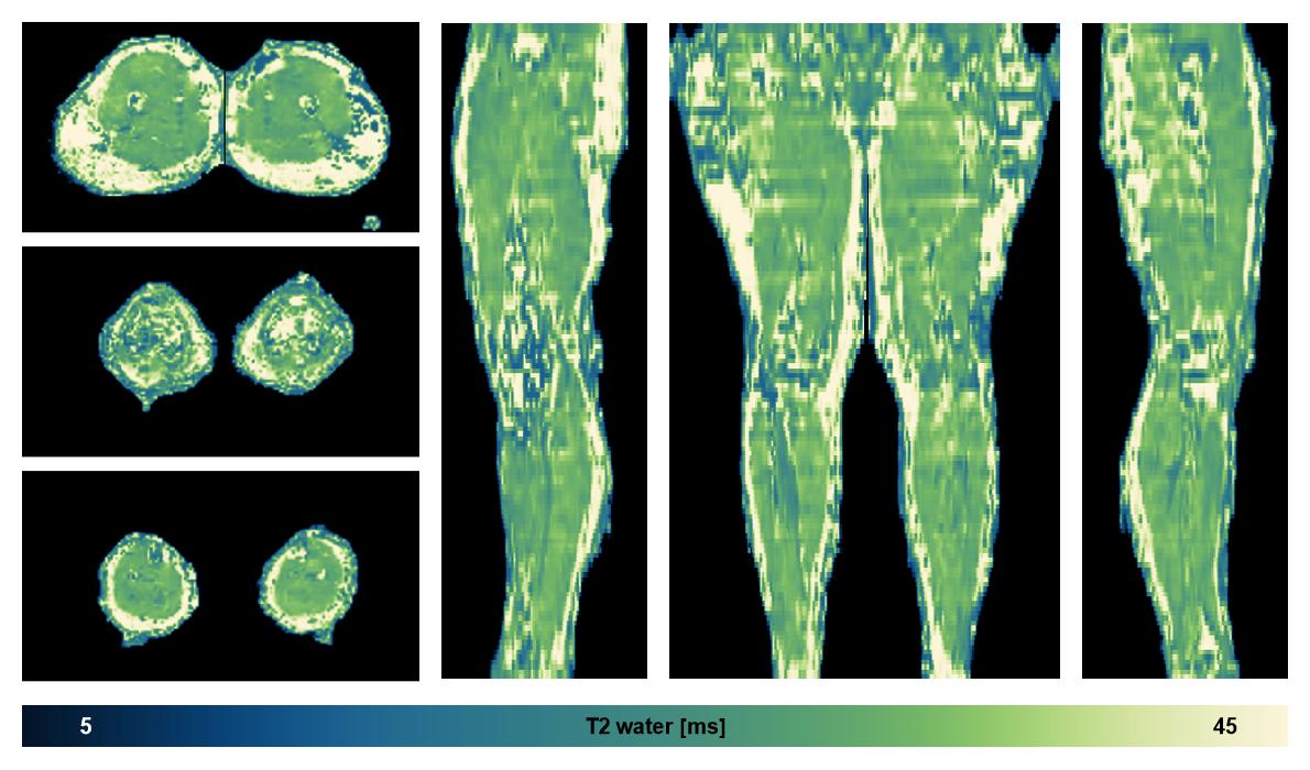 The water only T2 relaxation time of the lower extremity obtained from multi echo spin echo t2 mapping with EPG based reconstruction.