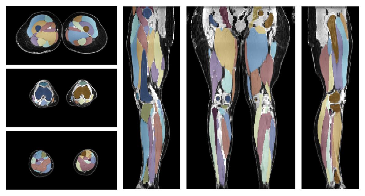 Overlay of automated muscle segmentation labels on dixon water image.