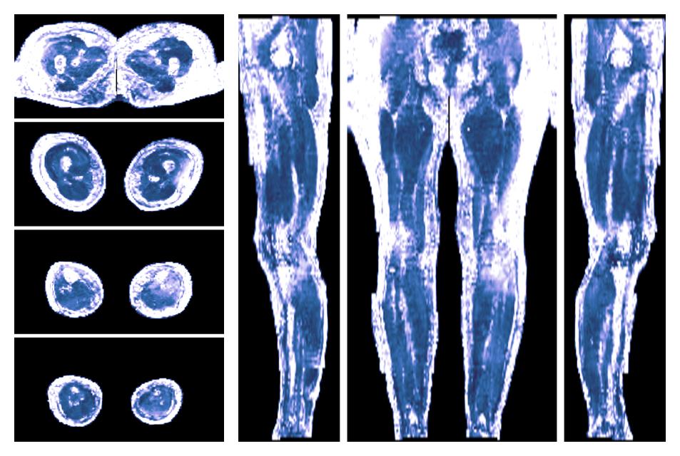 IVIM corrected whole leg muscle fractional anisotropy obtained from diffusion tensor imaging.