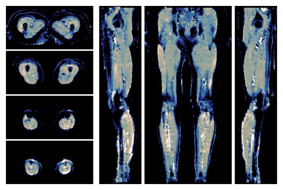 IVIM corrected whole leg muscle mean diffusivity obtained from diffusion tensor imaging.