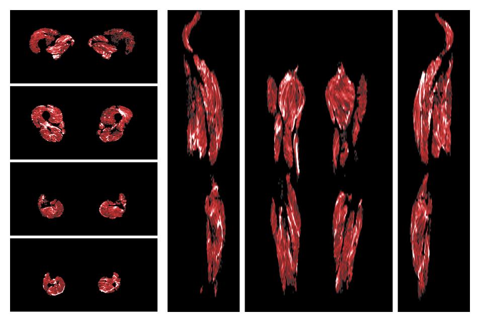 Muscle fiber tract density map based on whole leg DTI based fiber tractography.