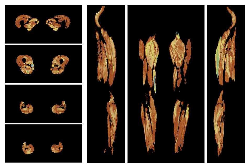 Muscle fiber tract length map based on whole leg DTI based fiber tractography.