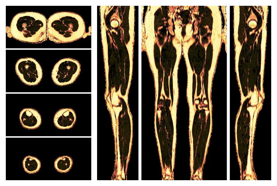 The fat fraction of the lower extremity obtained from the dixon reconstruction for muscle water fat quantification.