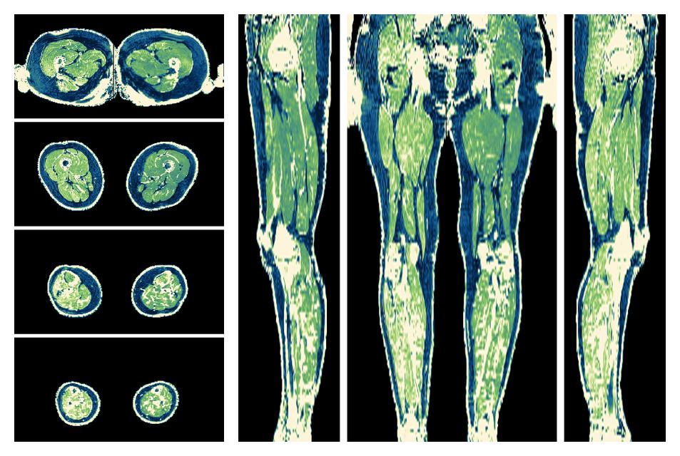 The R2 star relaxation time of the lower extremity obtained from the dixon reconstruction for muscle water fat quantification.