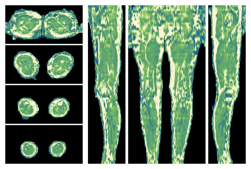 The water only T2 relaxation time of the lower extremity obtained from multi echo spin echo t2 mapping with EPG based reconstruction.