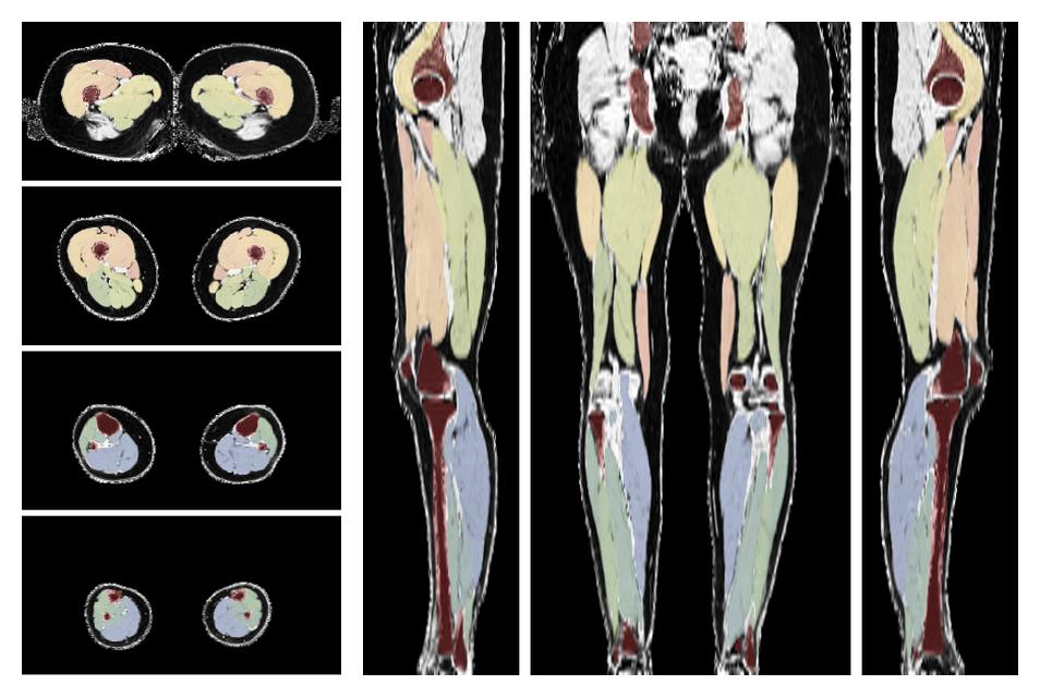 Overlay of automated muscle segmentation labels on dixon water image.