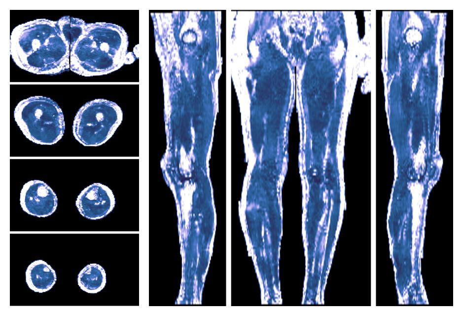 IVIM corrected whole leg muscle fractional anisotropy obtained from diffusion tensor imaging.