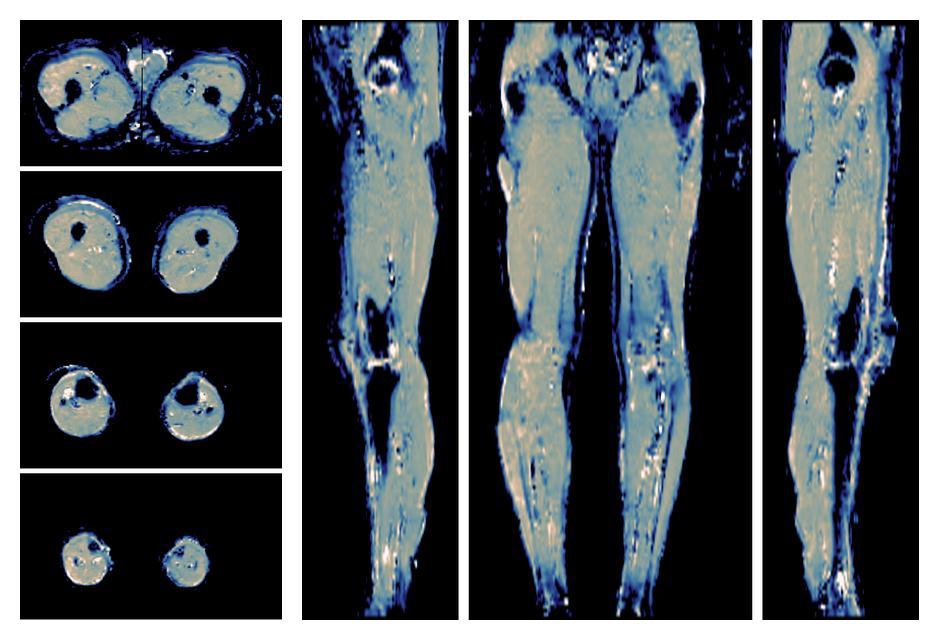 IVIM corrected whole leg muscle mean diffusivity obtained from diffusion tensor imaging.