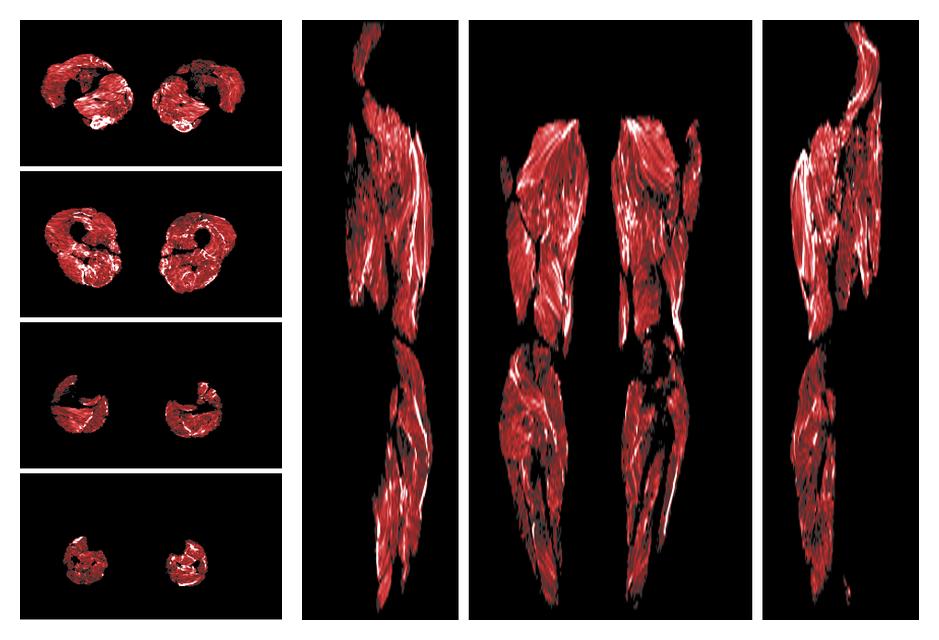 Muscle fiber tract density map based on whole leg DTI based fiber tractography.