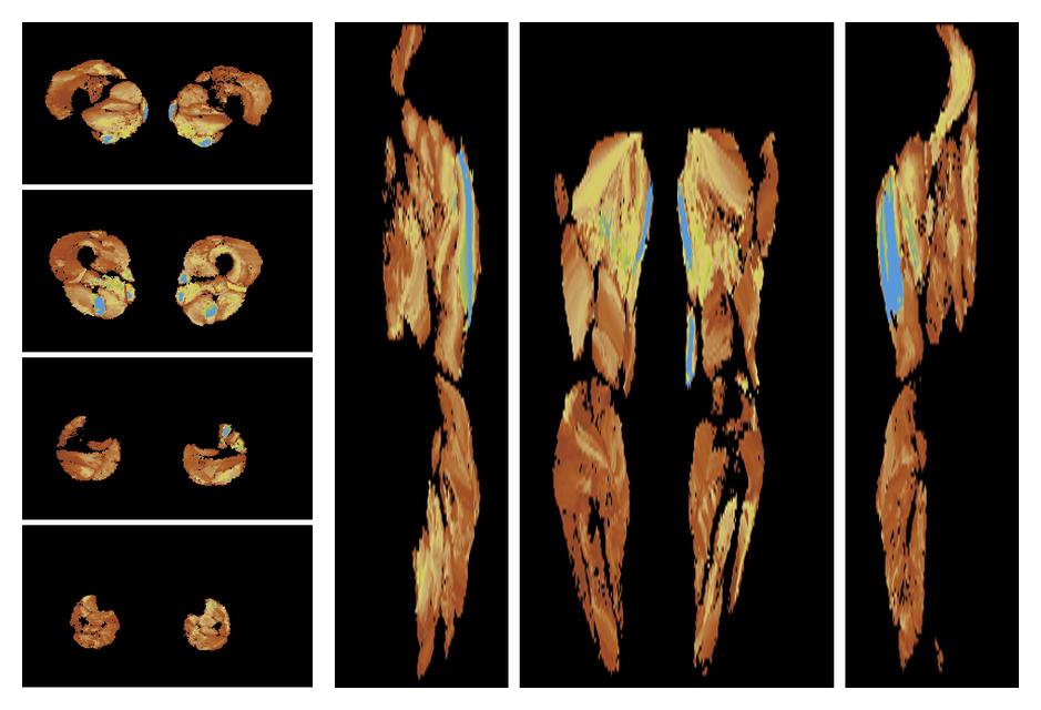 Muscle fiber tract length map based on whole leg DTI based fiber tractography.