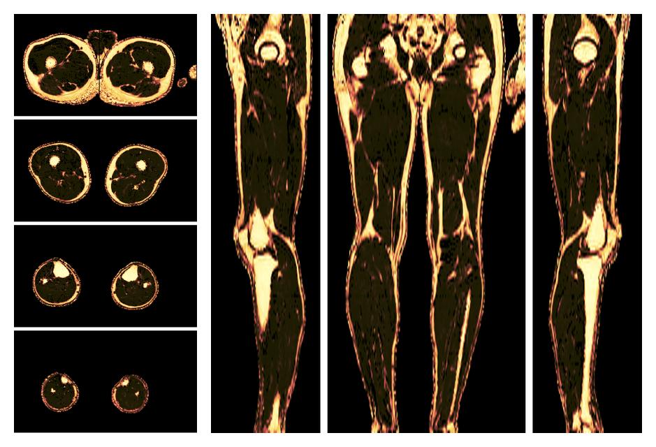 The fat fraction of the lower extremity obtained from the dixon reconstruction for muscle water fat quantification.