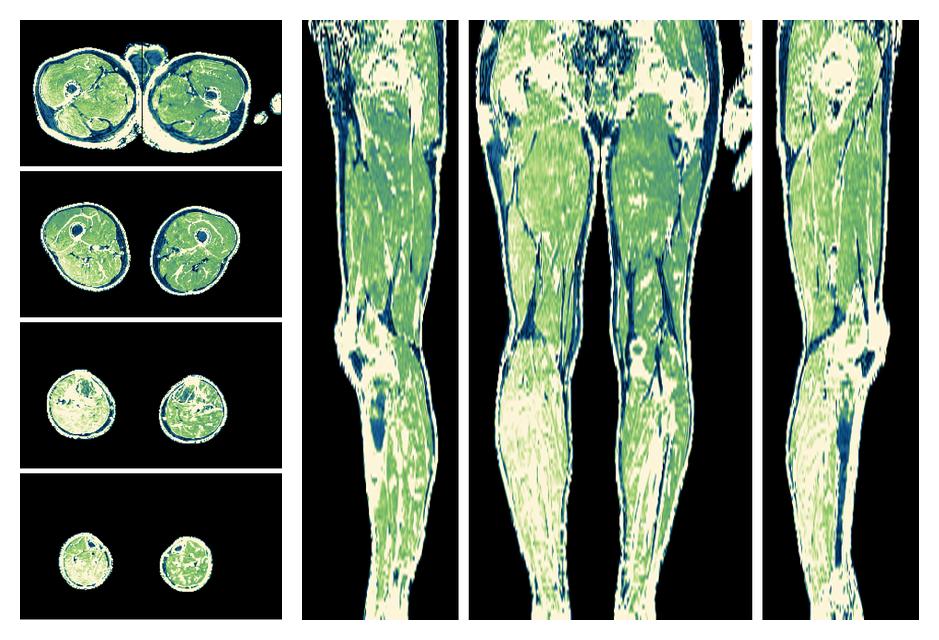 The R2 star relaxation time of the lower extremity obtained from the dixon reconstruction for muscle water fat quantification.