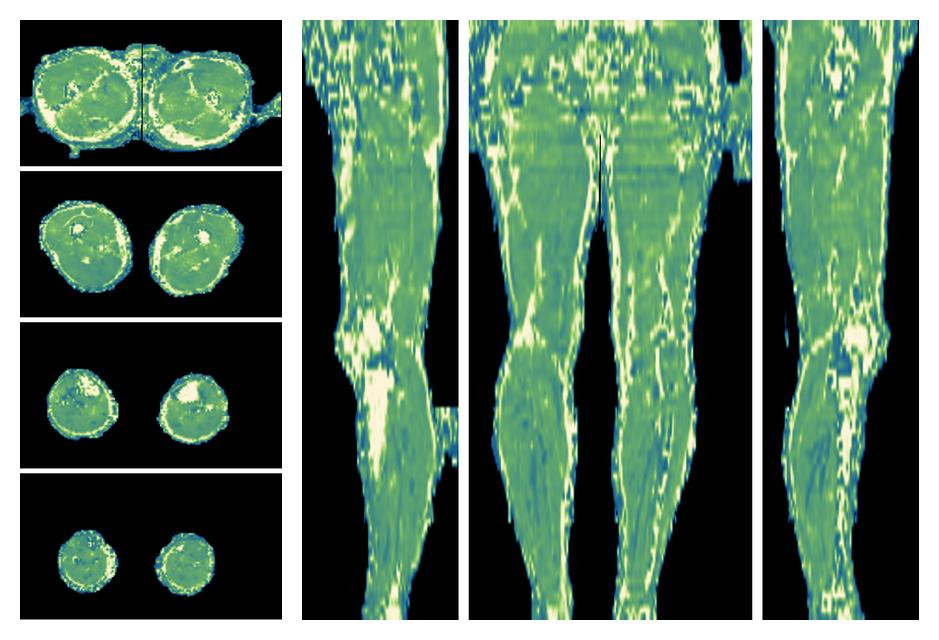 The water only T2 relaxation time of the lower extremity obtained from multi echo spin echo t2 mapping with EPG based reconstruction.