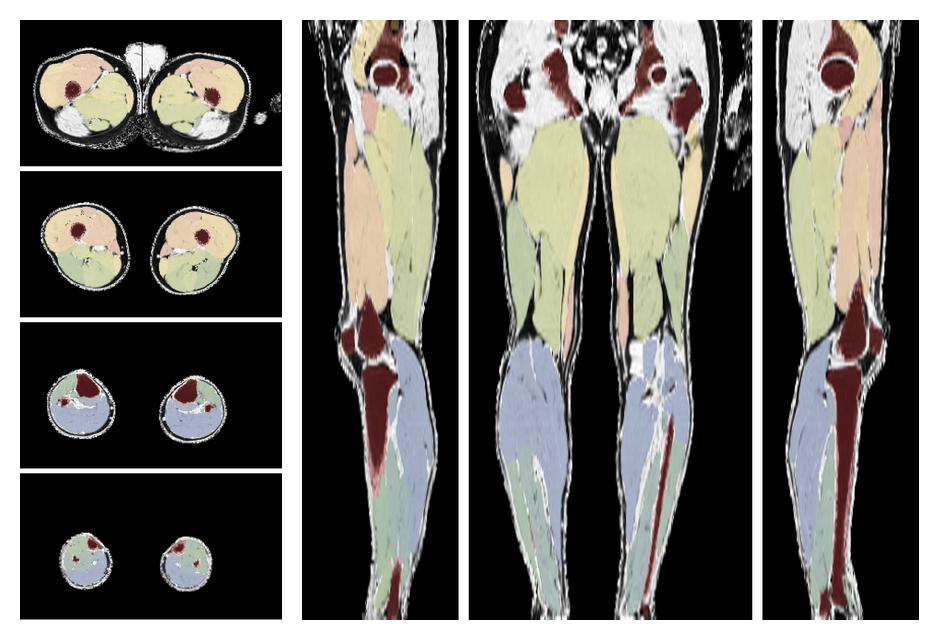 Overlay of automated muscle segmentation labels on dixon water image.