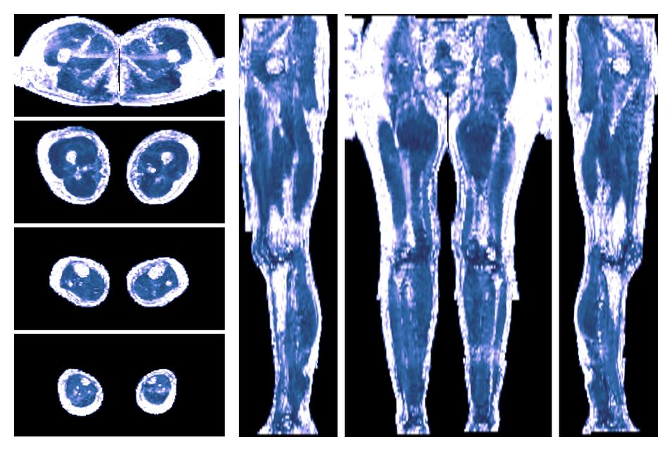 IVIM corrected whole leg muscle fractional anisotropy obtained from diffusion tensor imaging.