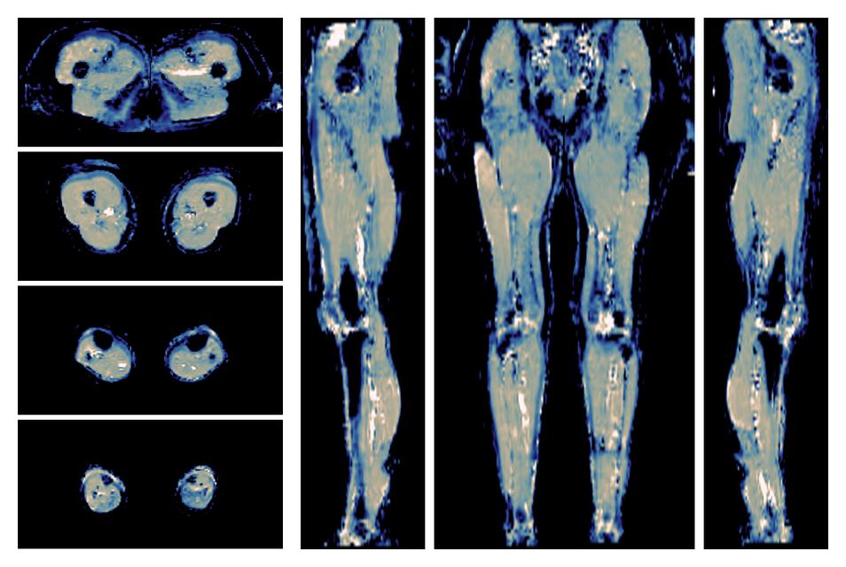 IVIM corrected whole leg muscle mean diffusivity obtained from diffusion tensor imaging.