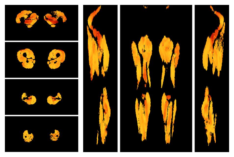 Muscle fiber tract angle map based on whole leg DTI based fiber tractography.