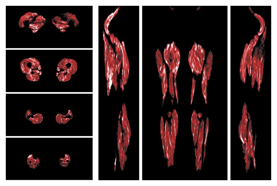 Muscle fiber tract density map based on whole leg DTI based fiber tractography.