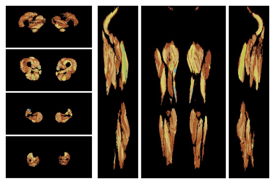 Muscle fiber tract length map based on whole leg DTI based fiber tractography.