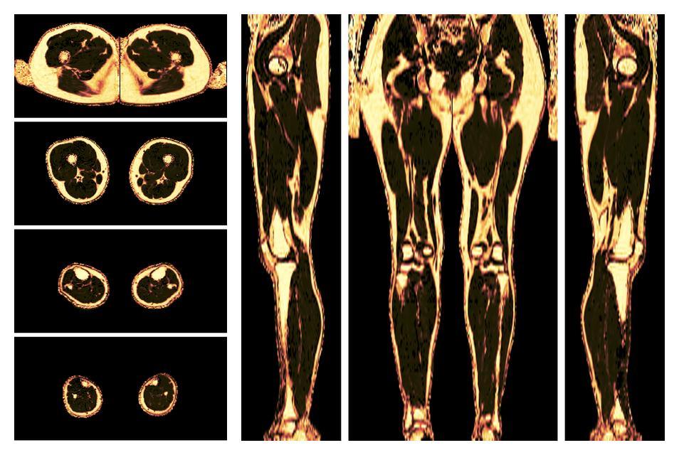 The fat fraction of the lower extremity obtained from the dixon reconstruction for muscle water fat quantification.