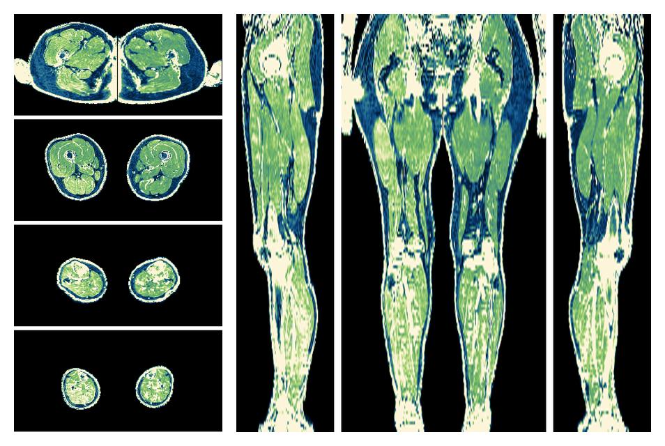 The R2 star relaxation time of the lower extremity obtained from the dixon reconstruction for muscle water fat quantification.