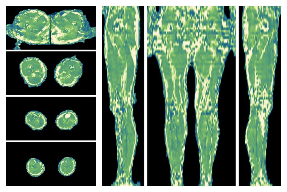 The water only T2 relaxation time of the lower extremity obtained from multi echo spin echo t2 mapping with EPG based reconstruction.