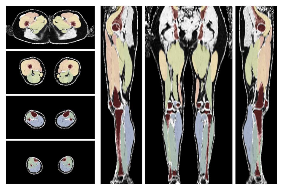 Overlay of automated muscle segmentation labels on dixon water image.