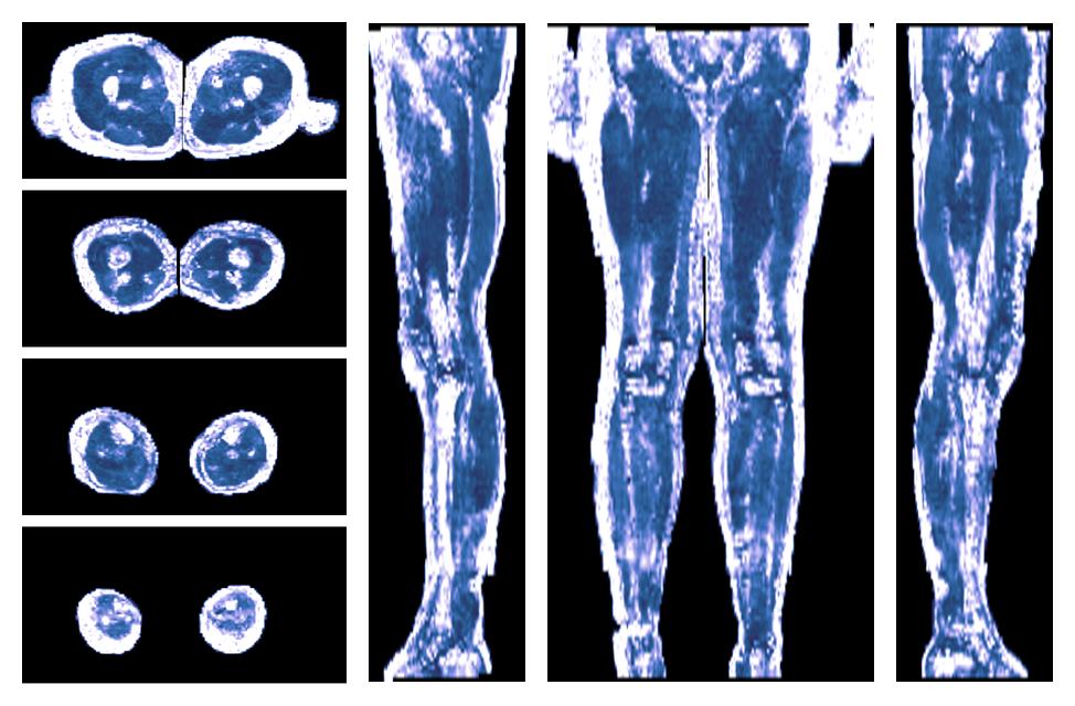 IVIM corrected whole leg muscle fractional anisotropy obtained from diffusion tensor imaging.