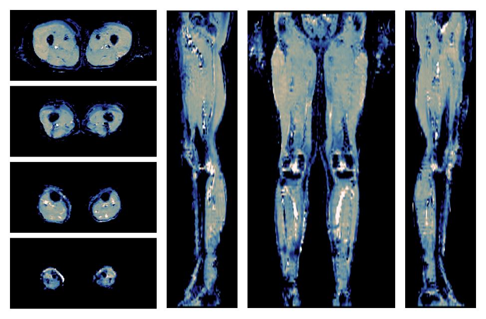 IVIM corrected whole leg muscle mean diffusivity obtained from diffusion tensor imaging.