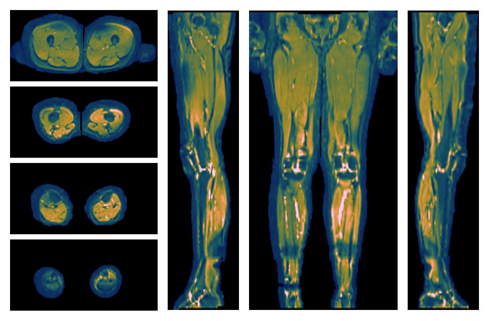 SNR distribution of the unweighted diffusion data.