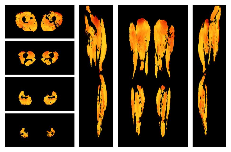 Muscle fiber tract angle map based on whole leg DTI based fiber tractography.