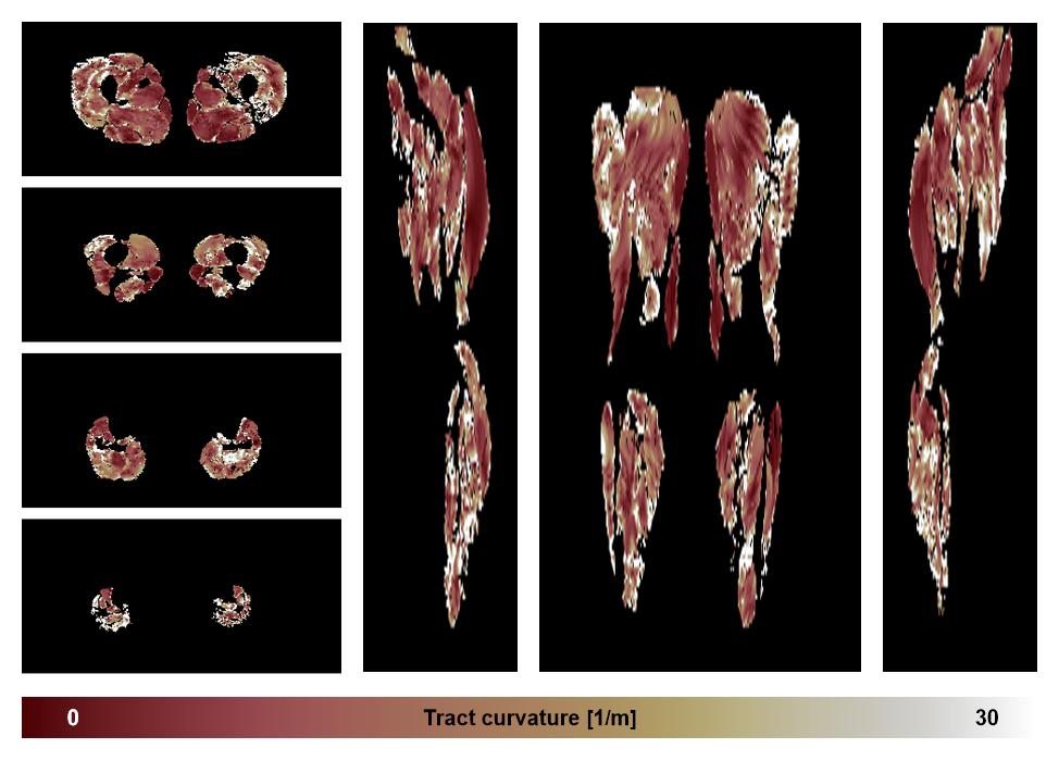 Muscle fiber tract curvature map based on whole leg DTI based fiber tractography.