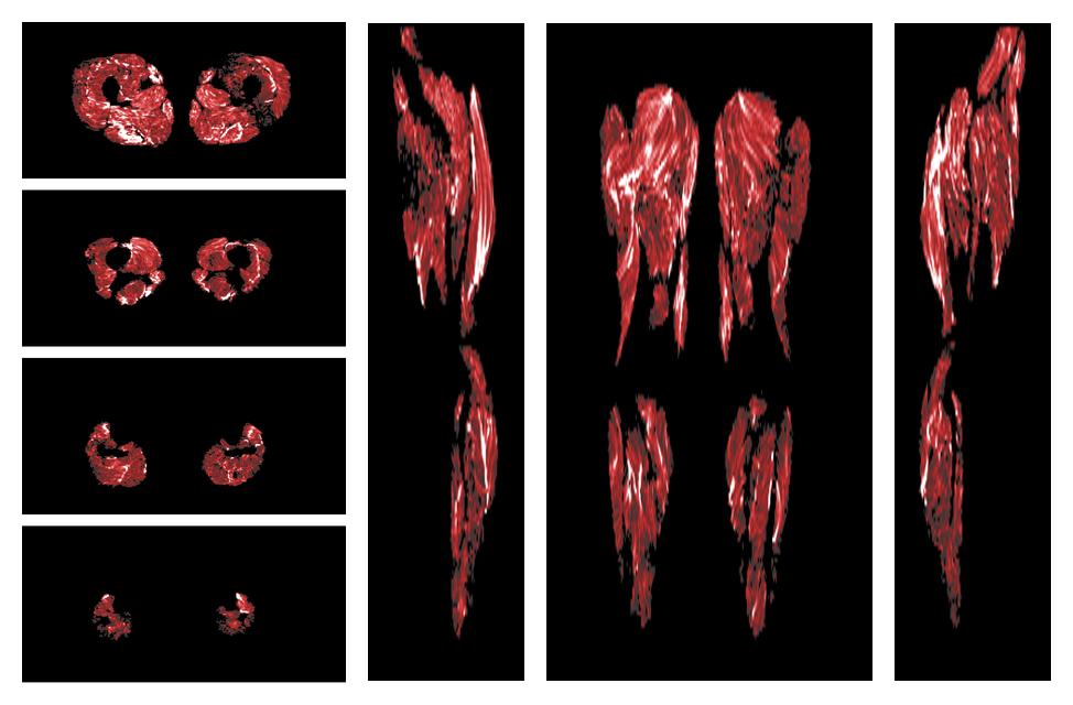 Muscle fiber tract density map based on whole leg DTI based fiber tractography.