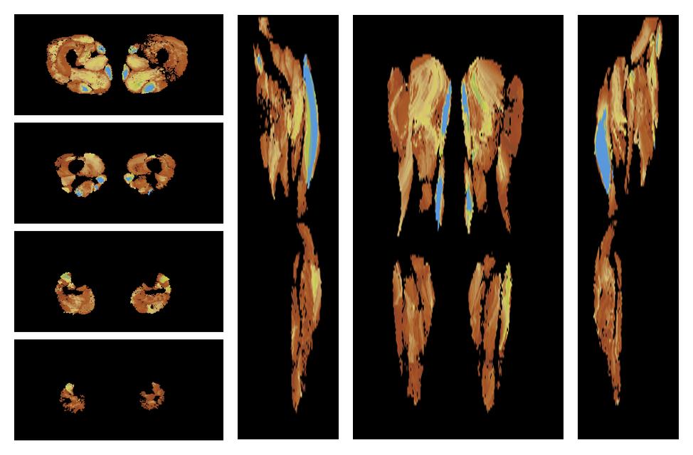 Muscle fiber tract length map based on whole leg DTI based fiber tractography.