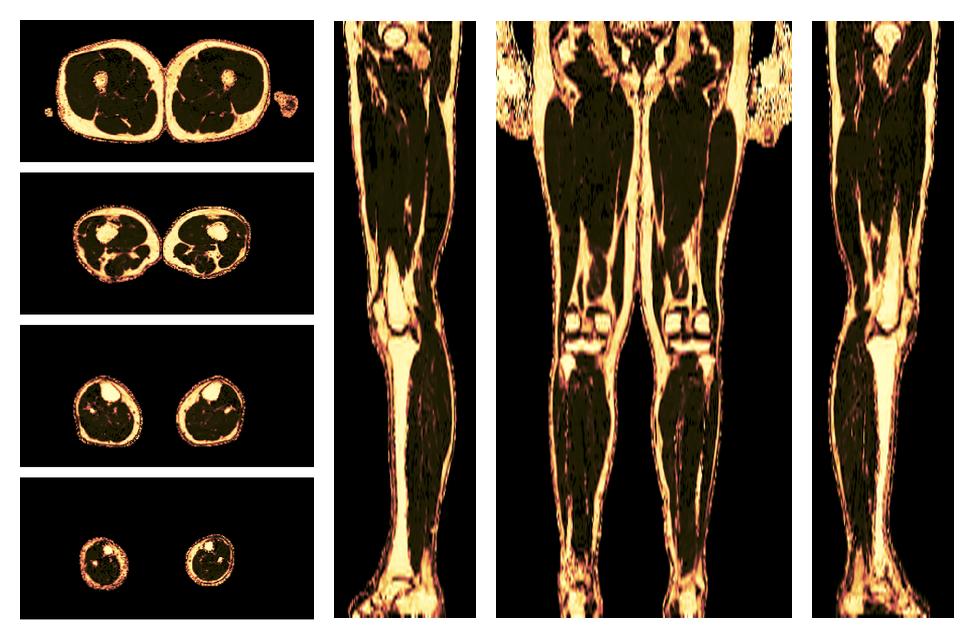 The fat fraction of the lower extremity obtained from the dixon reconstruction for muscle water fat quantification.