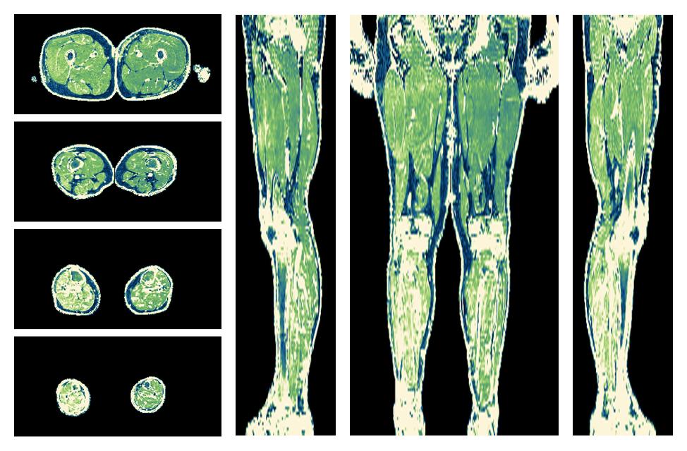 The R2 star relaxation time of the lower extremity obtained from the dixon reconstruction for muscle water fat quantification.