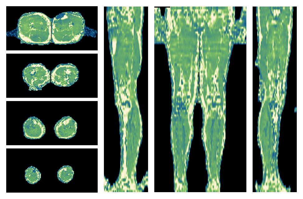 The water only T2 relaxation time of the lower extremity obtained from multi echo spin echo t2 mapping with EPG based reconstruction.