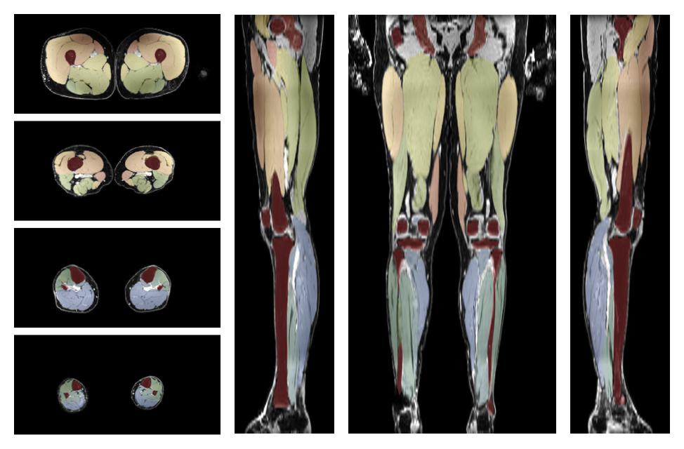 Overlay of automated muscle segmentation labels on dixon water image.