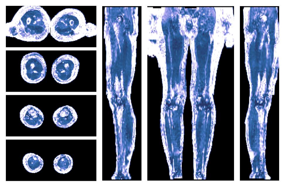 IVIM corrected whole leg muscle fractional anisotropy obtained from diffusion tensor imaging.