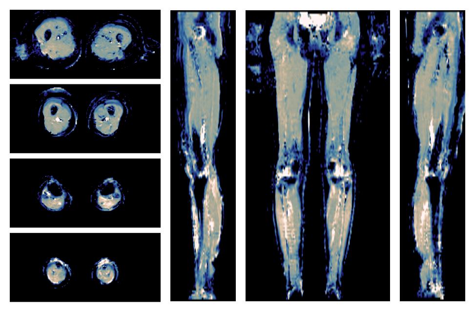 IVIM corrected whole leg muscle mean diffusivity obtained from diffusion tensor imaging.