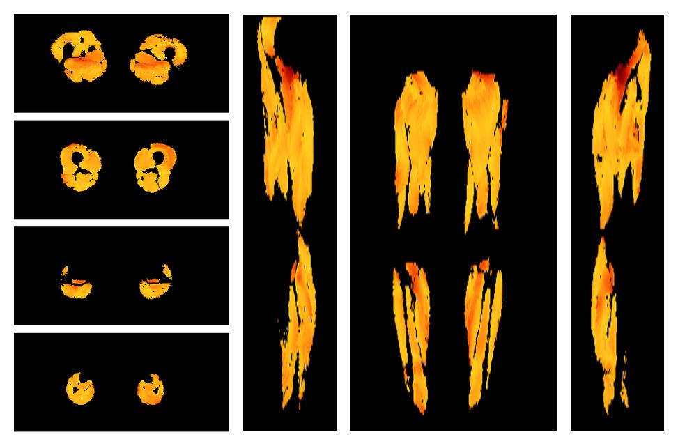 Muscle fiber tract angle map based on whole leg DTI based fiber tractography.