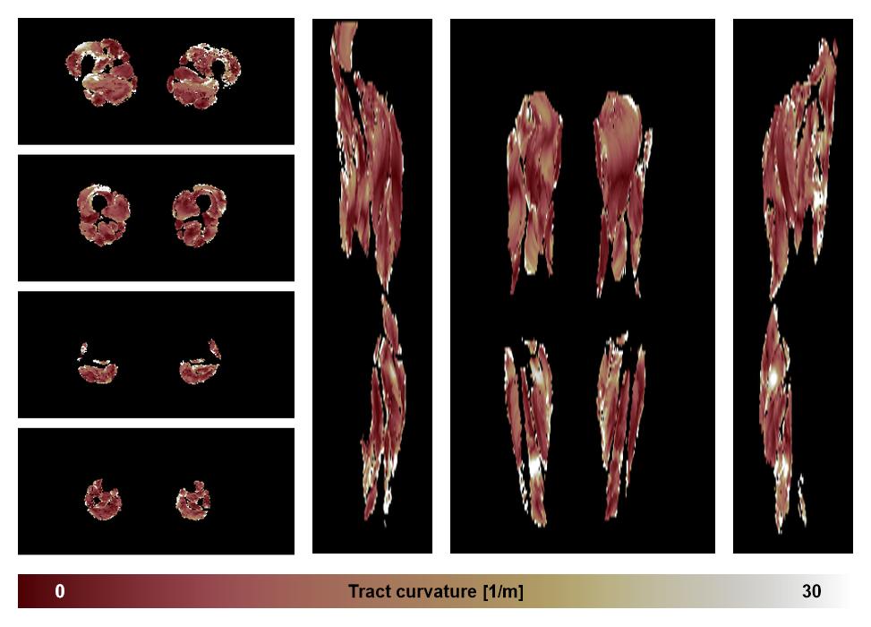 Muscle fiber tract curvature map based on whole leg DTI based fiber tractography.